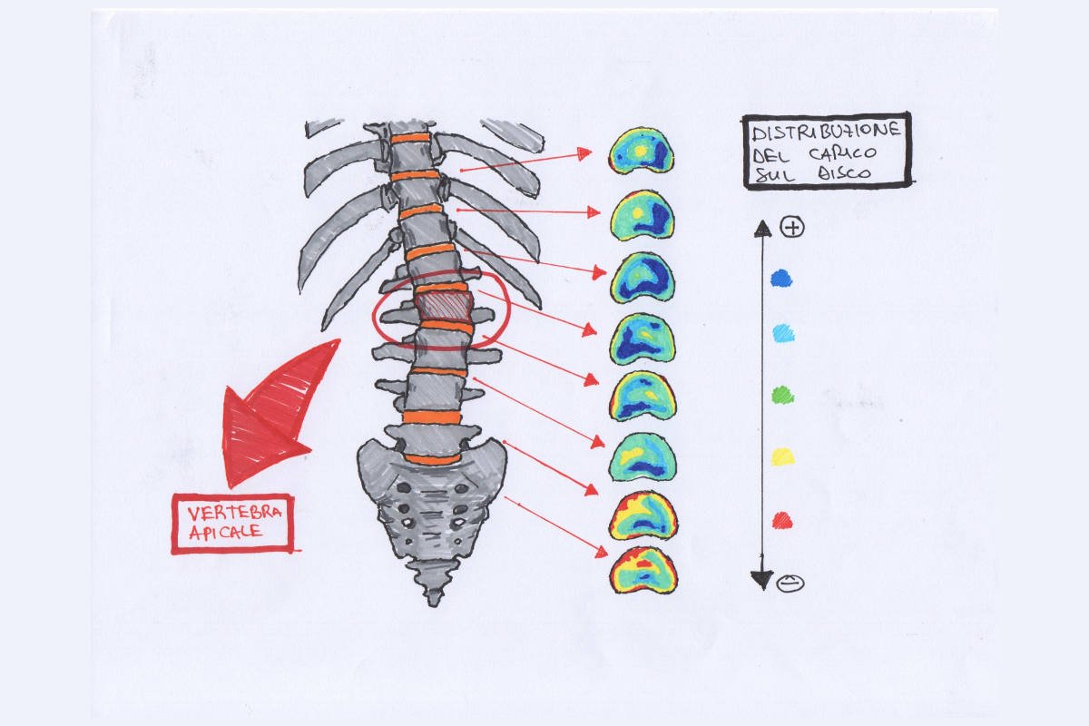 Sviluppo della scoliosi: perché può peggiorare nella crescita?