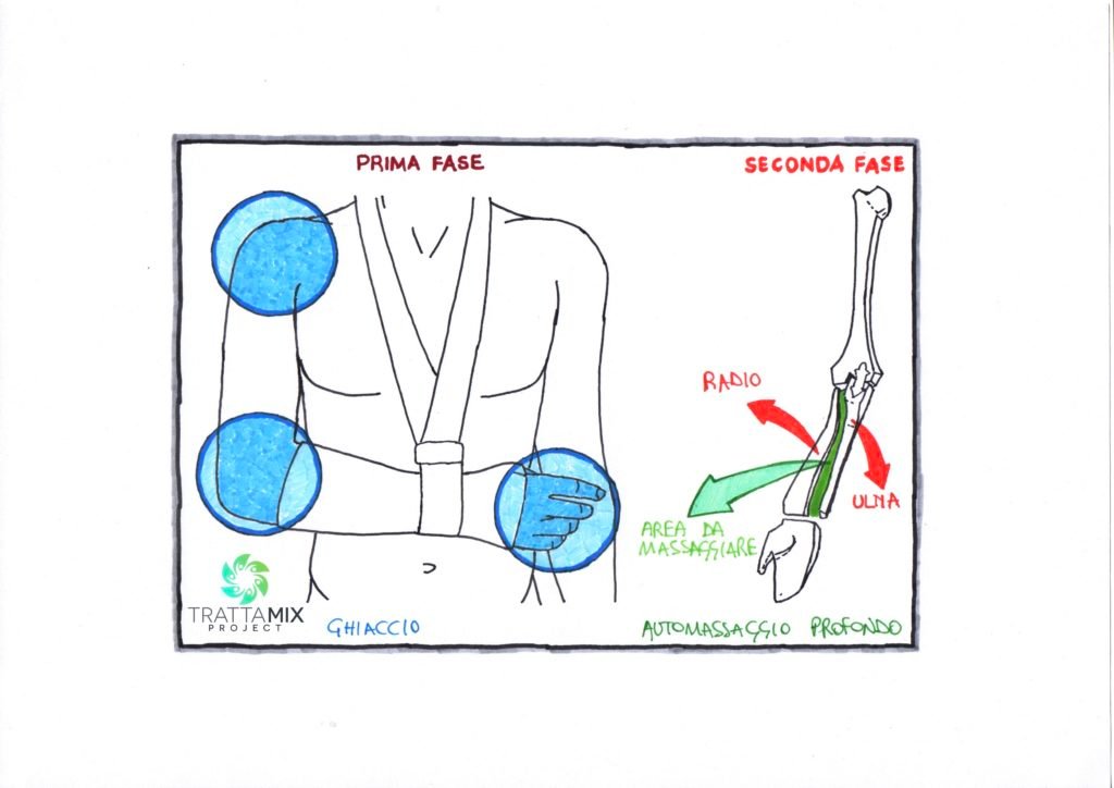 Frattura polso riabilitazione a casa