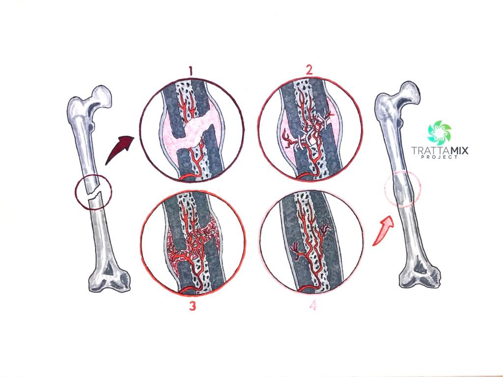in quanto tempo si calcifica una frattura