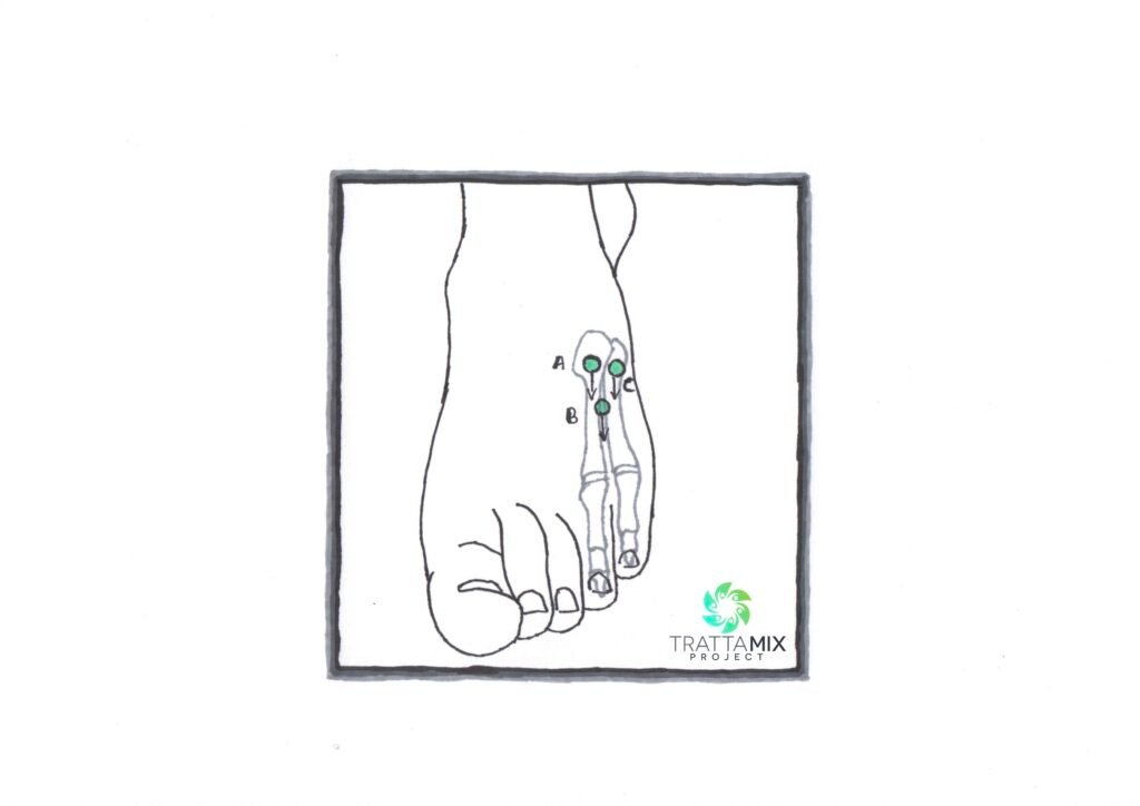 frattura mignolo piede camminare