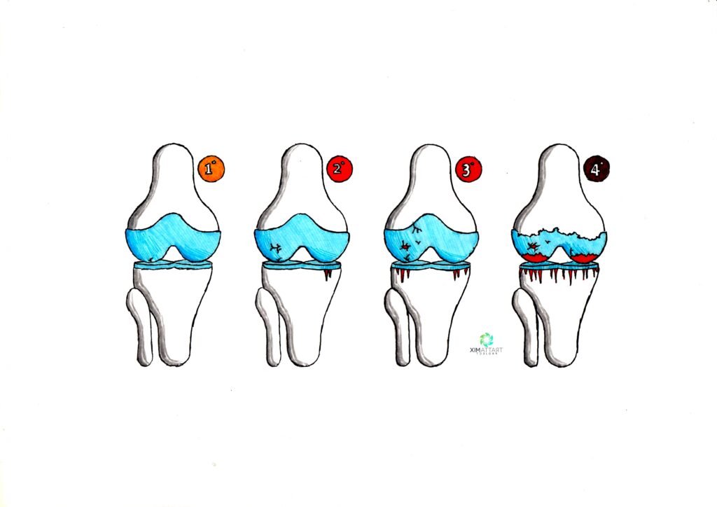 condropatia femoro-rotulea