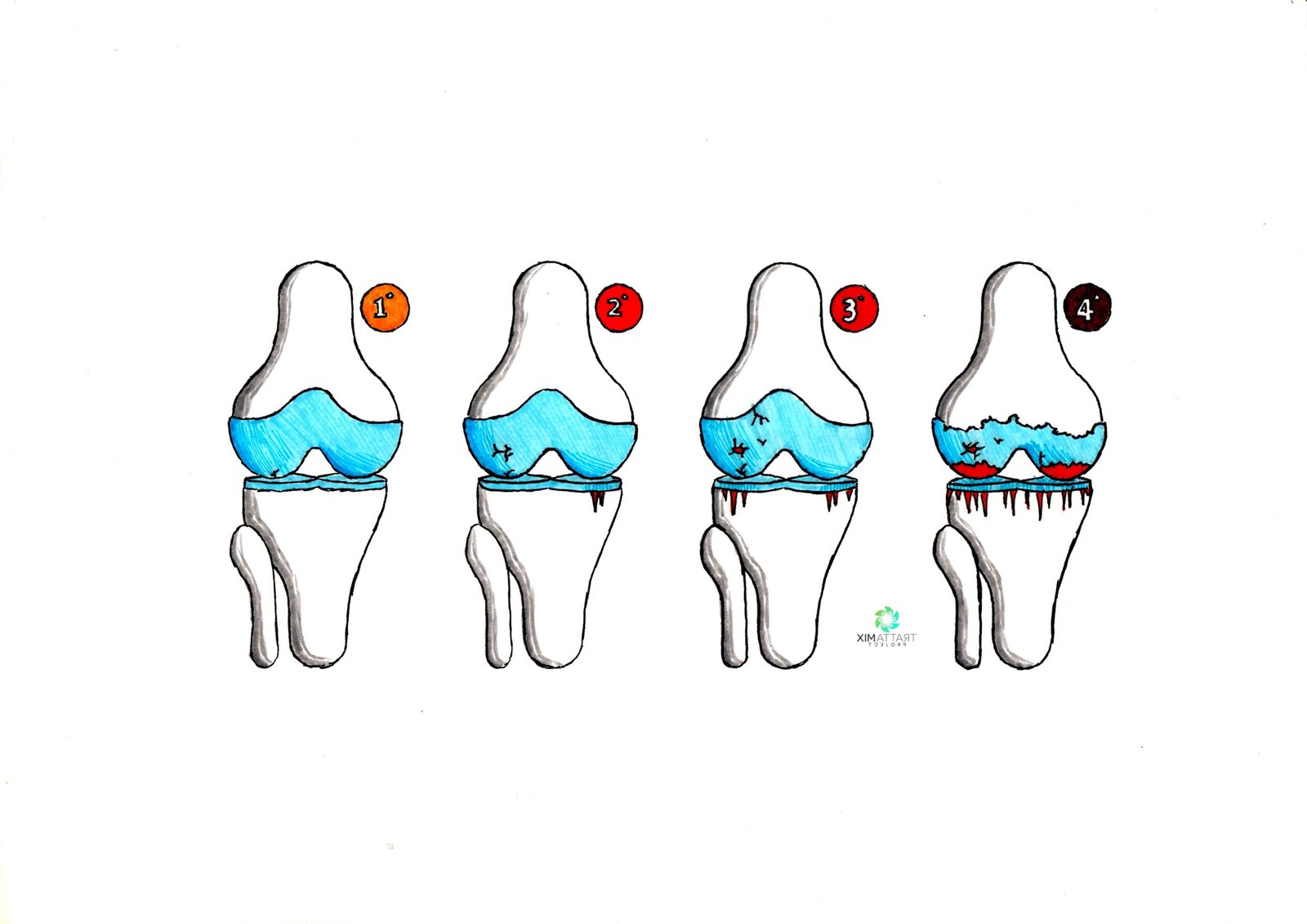condropatia femoro-rotulea
